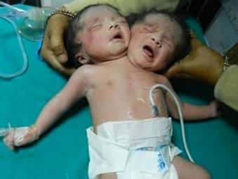 Nació una beba de dos cabezas en la India