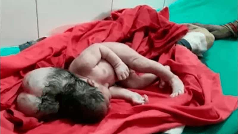 Nació una beba con "tres cabezas" en India