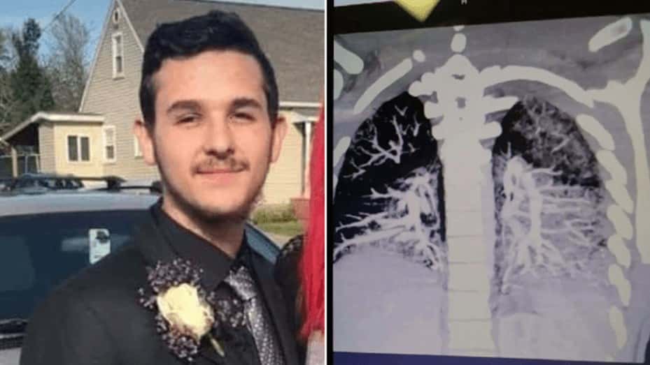 El joven de 19 años que tiene pulmones de un fumador de 60 por el cigarrillo electrónico