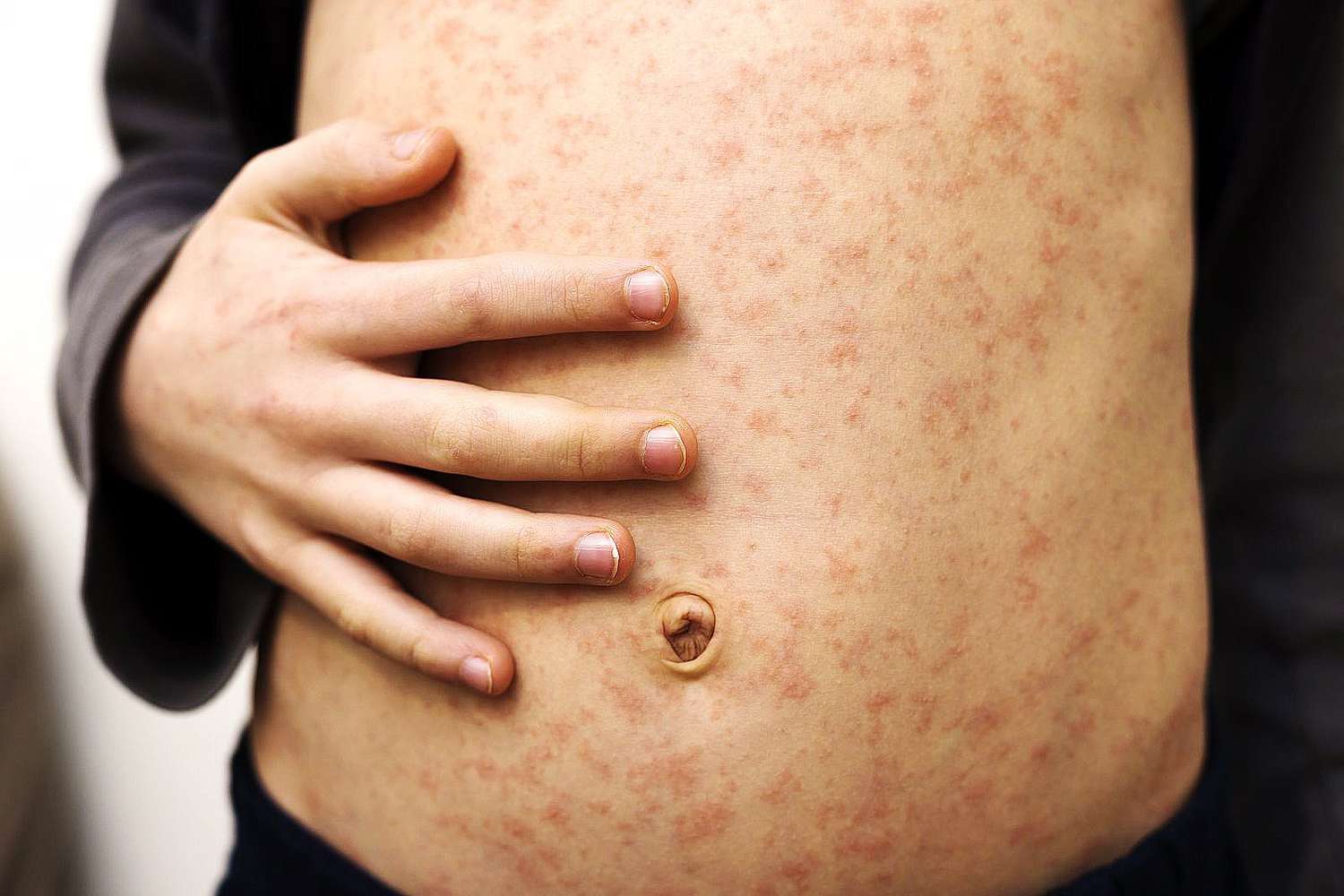 Confirmaron 18 casos de sarampión: ¿Cuáles son las nuevas medidas a tomar?