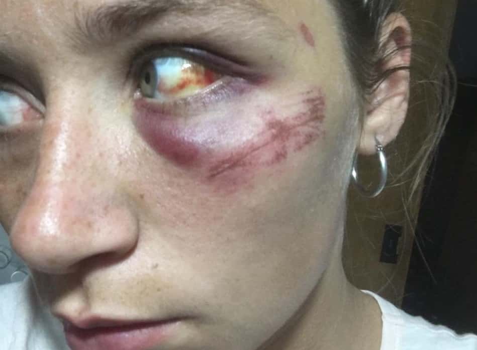 Horror en Larroque: La golpeaba y para disimular el hematoma le frotó un leño en el ojo