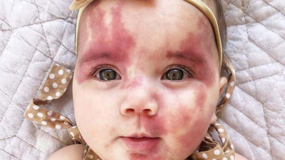 Llamaron "fea" a su hija por tener marcas de nacimiento y dio una lección de amor 