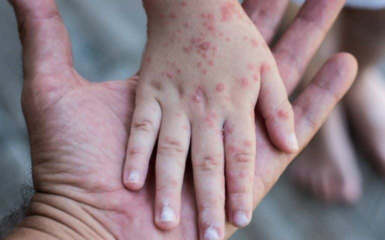 El Gobierno alertó por brotes de sarampión en la región