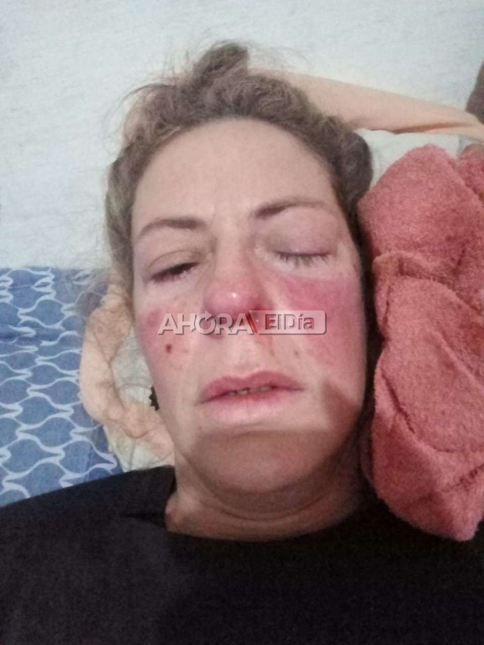 Horror en Gualeguaychú: Su ex pareja la golpeó y ahora deberán operarla para reconstruirle la cara