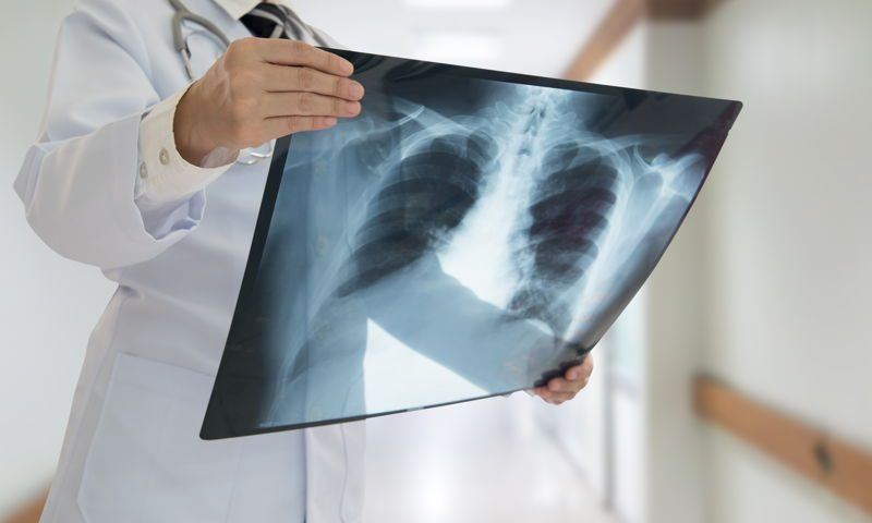 Gualeguaychú asiste a un incremento de casos de Tuberculosis al igual que el resto Entre Ríos